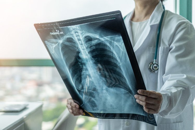 lung cancer treatment
